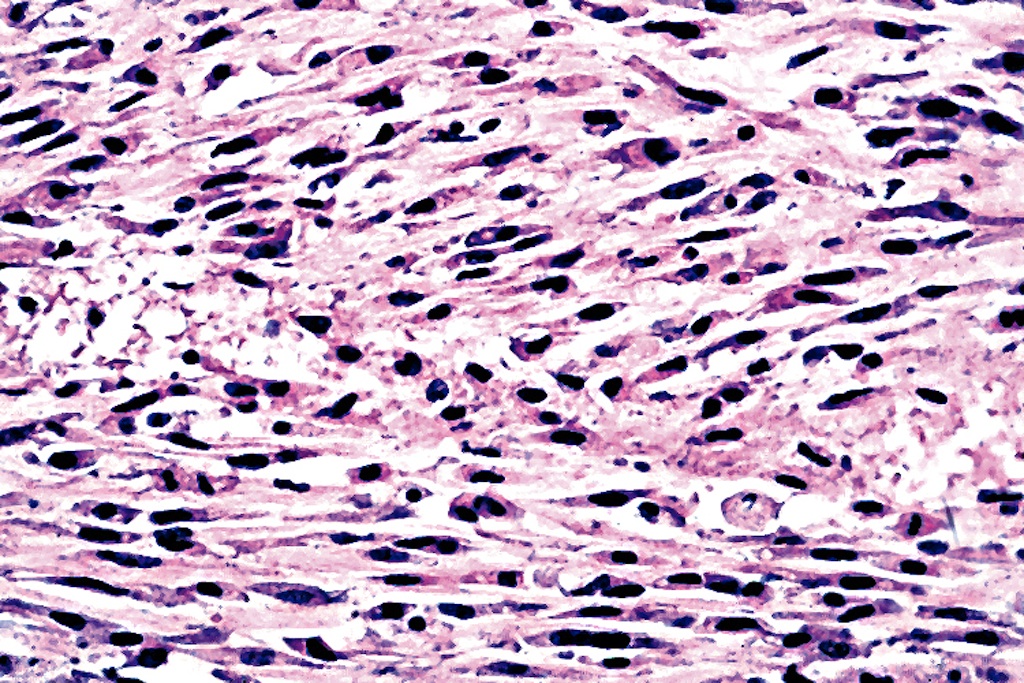 Pathology Outlines Anaplastic carcinoma